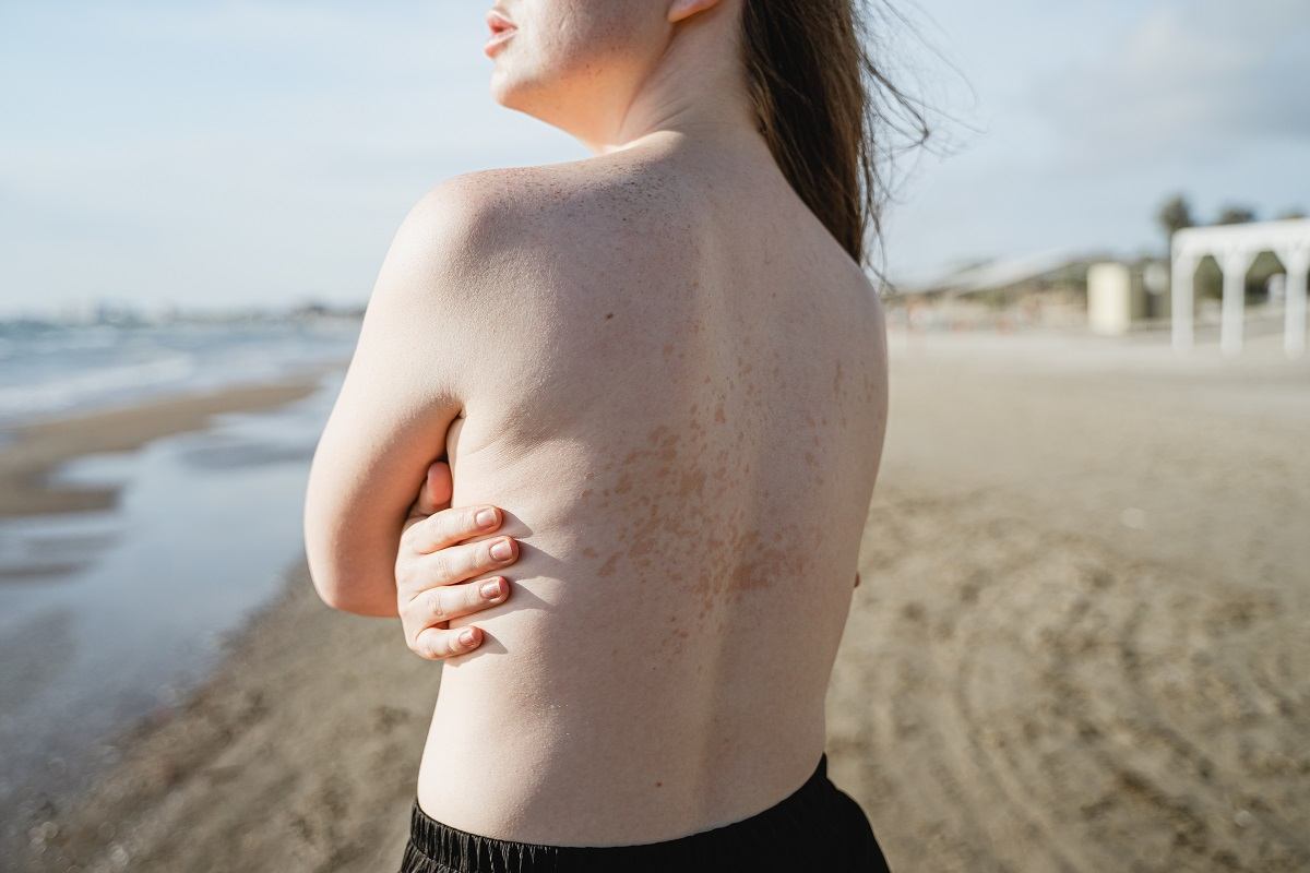 жена на плажа със слънчева алергия